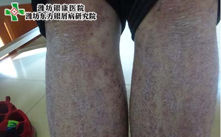银屑病症状,进行期银屑病症状