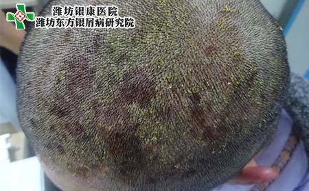 银屑病治疗,银屑病好的治疗