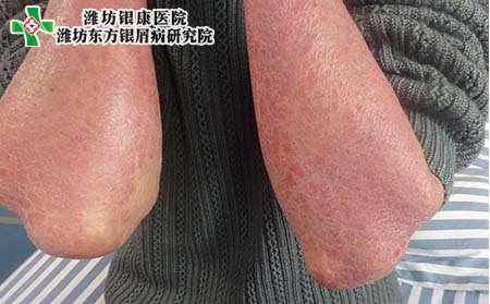 潍坊银屑病研究院:银屑病护理、图片